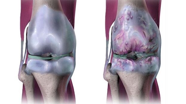 Sendi lutut yang sihat dan terjejas oleh osteoartritis