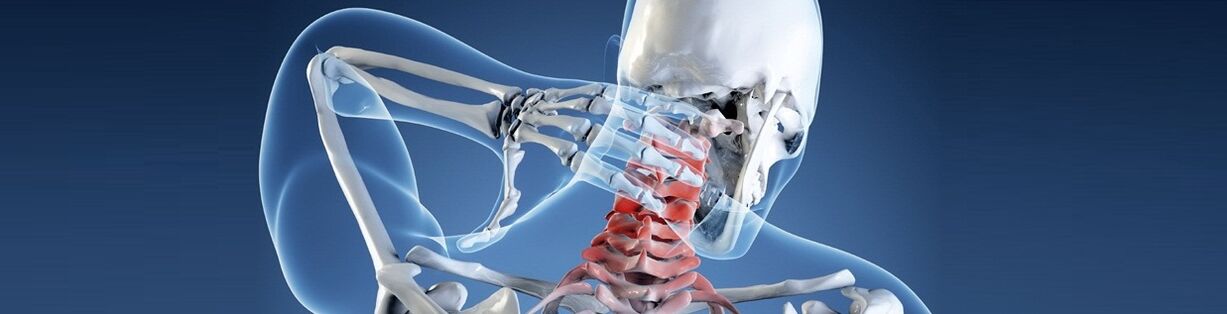 Osteochondrosis tulang belakang serviks manusia