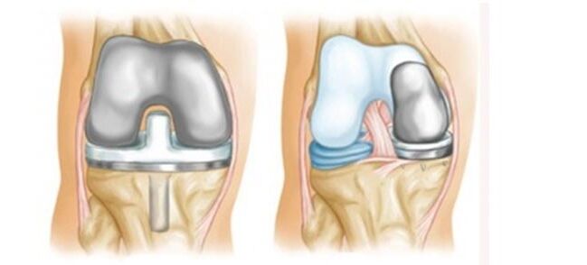 Endoprosthetics untuk osteoartritis sendi lutut
