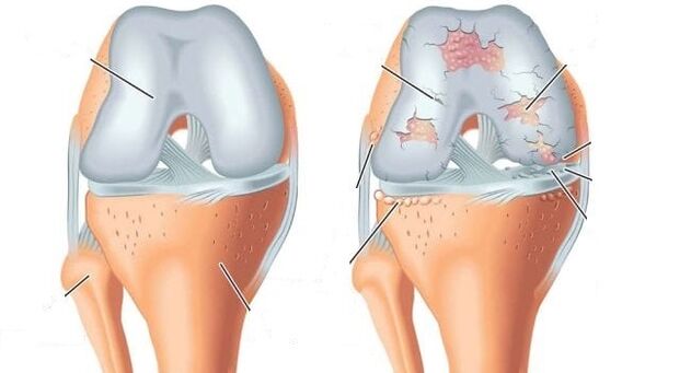 sendi dan osteoartritis sendi lutut yang sihat