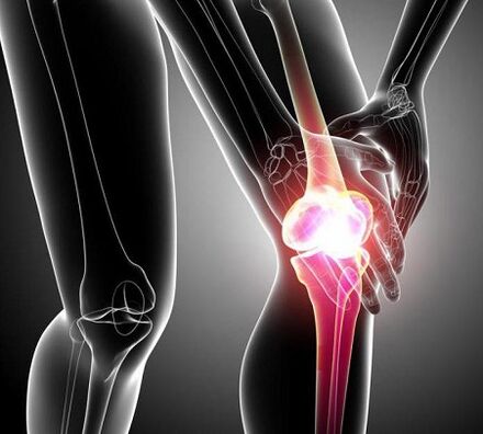 Kerosakan pada sendi lutut akibat artritis dan osteoartritis