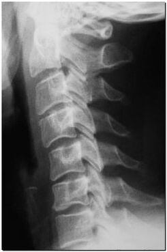 X-ray tulang belakang serviks