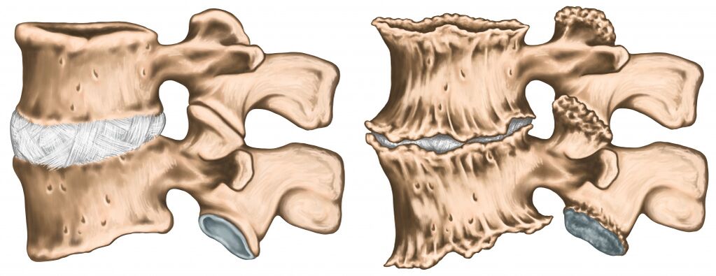 Sakit belakang akibat kecederaan tulang belakang