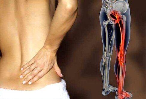 Sakit belakang akibat keradangan saraf sciatic