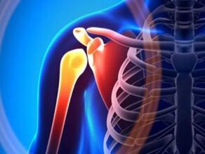 Sendi bahu yang meradang akibat osteoarthritis – penyakit kronik sistem muskuloskeletal