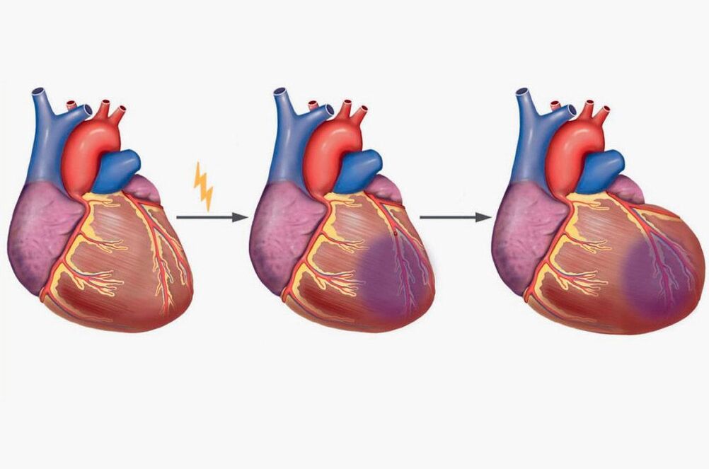 Serangan jantung menyebabkan sakit pada tulang belikat