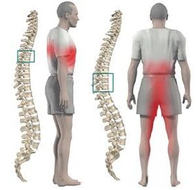 Sakit dengan Chondrosis Payudara boleh diberikan kepada anggota badan yang lebih rendah dan langkahnya