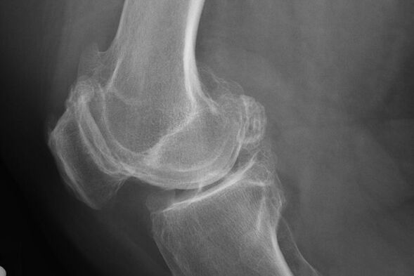 Kaedah untuk mendiagnosis osteoarthritis lutut