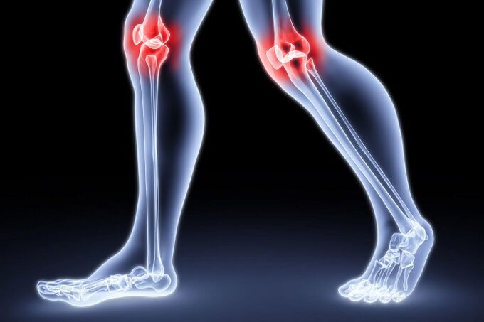 Sakit lutut akibat arthritis dan osteoarthritis
