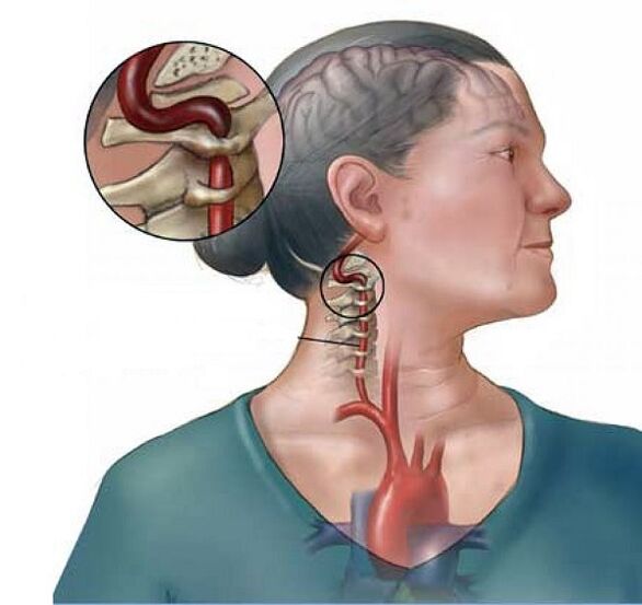 Sindrom arteri vertebral dengan osteochondrosis serviks