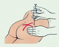 Suntikan untuk rawatan osteochondrosis