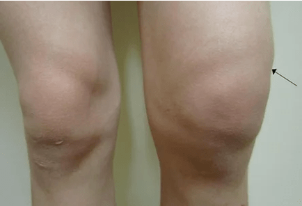 Hemarthrosis sendi lutut